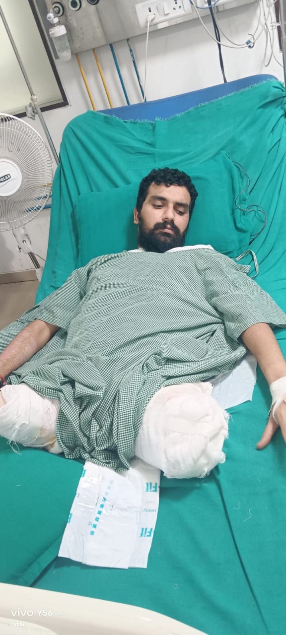 दुर्घटना में कट गये थे दोनों पांव : फिर भी बचा ली जान