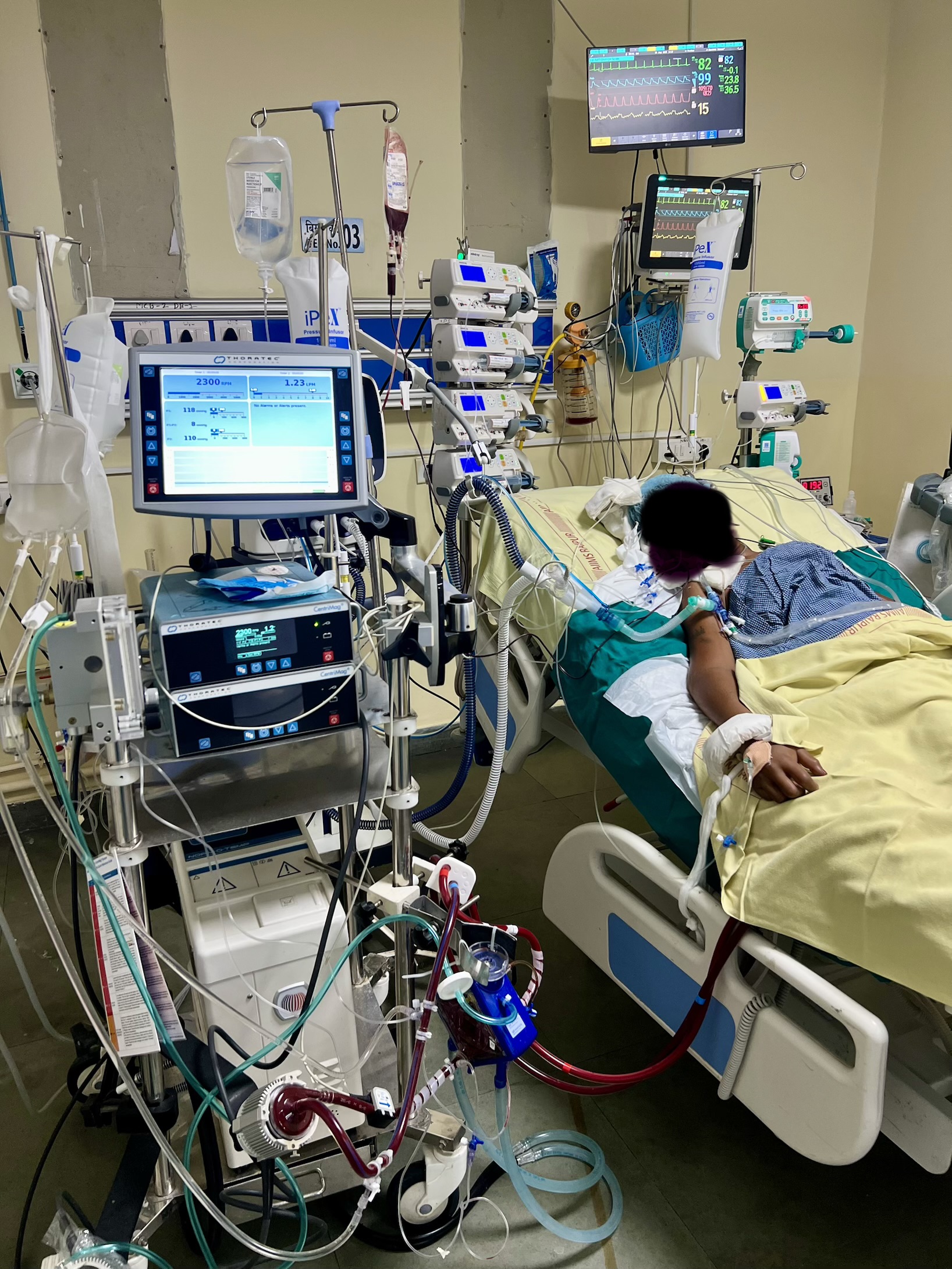 एम्स रायपुर ने छत्तीसगढ़ में किया पहला सफल वीए-ईसीएमओ केस