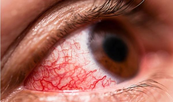  सावधान.... छत्तीसगढ़ में कंजेक्टिवाइटिस अब तक मिले 19 हजार मरीज... स्कूलों में तेजी से फैल रहा इंफेक्शन