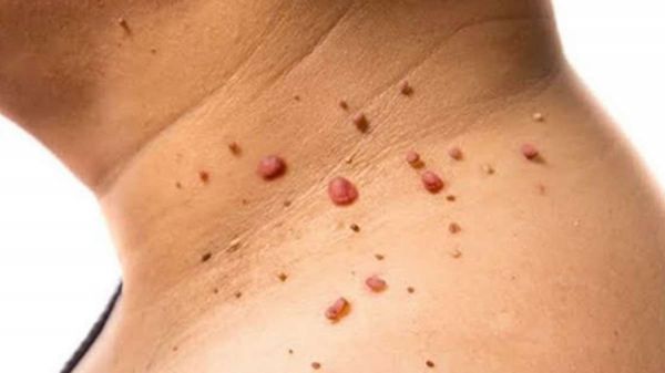 मस्सा को लेकर क्या आप भी हैं परेशान... महंगे उपचार से ज्यादा बेहतर हैं... ये घरेलू उपचार