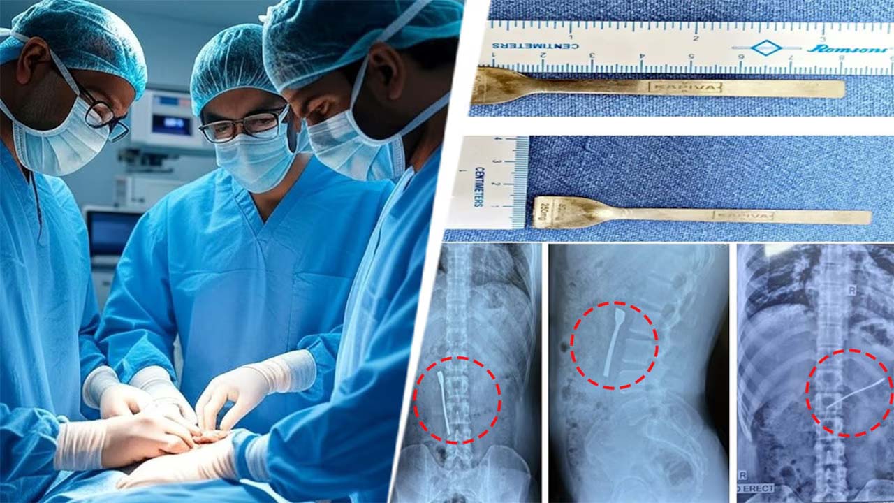 दिल्ली में हैरान करने वाला मामला, मरीज के पेट से निकाली 8 सेंटीमीटर लंबी चम्मच; डॉक्टर ने दी नई जिंदगी