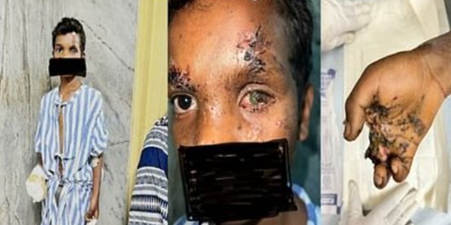 CG BREAKING NEWS : खेलते&mdash;खेलते फटा मोबाइल... एक हाथ की उंगलियां कटी... एक आंख की रोशनी भी गई