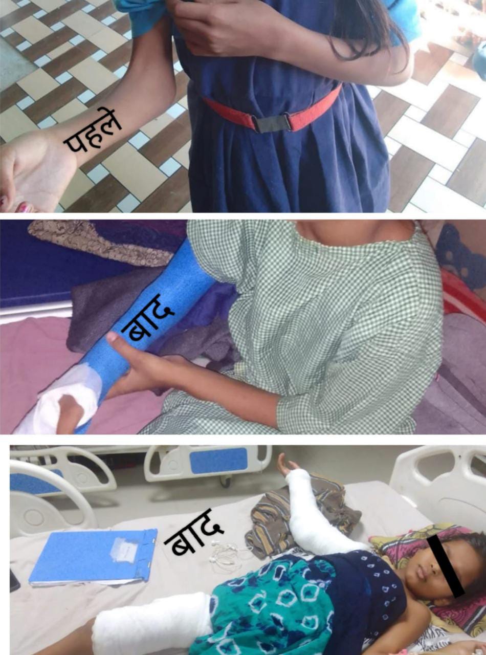 ऑपरेशन के बाद सीमा अब अपना हाथ सीधा कर पाएगी, &lsquo;चिरायु&rsquo; से डीकेएस अस्पताल में हुई निःशुल्क सर्जरी