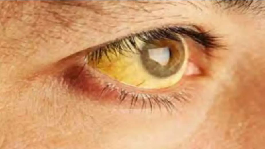 रायपुर के इस हॉस्टल में फैली पीलिया, 12 छात्राएं चपेट में