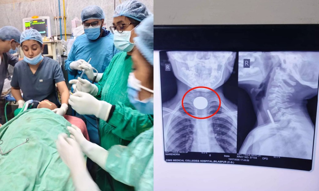 6 साल के मासूम के गले में फसा सिक्का, डॉक्टरों ने बचाई जान