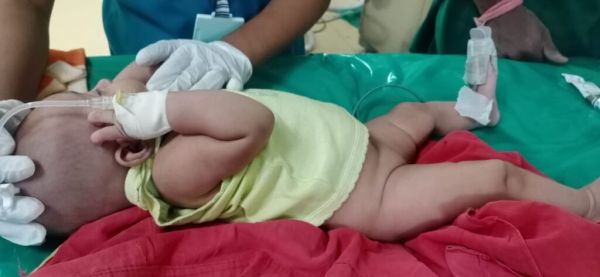 दो माह की बच्ची ने निगल लिया स्क्रू, डाक्टरों ने सफलतापूर्वक निकाला 