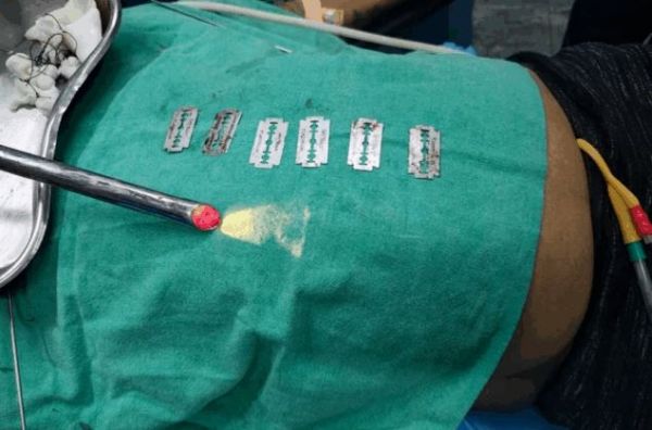 सिम्स अस्पताल की टीम ने दिखाई जान बचाने वाली सूझबूझ, बुजुर्ग के गले से निकाले 6 सेविंग ब्लेड