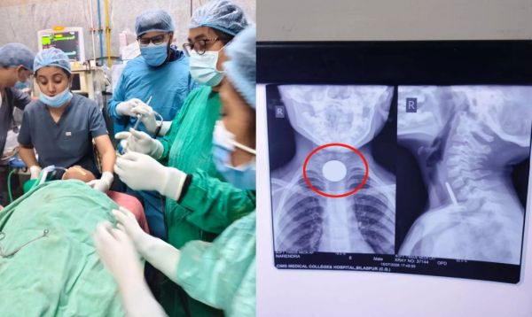 6 साल के मासूम के गले में फसा सिक्का, डॉक्टरों ने बचाई जान